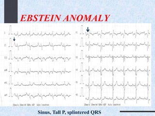 EBSTEIN ANOMALY
Sinus, Tall P, splintered QRS
 