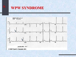 WPW SYNDROME6.
 