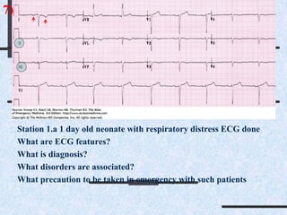 Station 1.a 1 day old neonate with respiratory distress ECG done
What are ECG features?
What is diagnosis?
What disorders are associated?
What precaution to be taken in emergency with such patients
7)
 