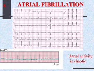 ATRIAL FIBRILLATION8.
Atrial activity
is chaotic
 