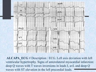 ALCAPA_ECG # Description : ECG. Left axis deviation with left
ventricular hypertrophy. Signs of anterolateral myocardial infarction:
deep Q waves with T waves inversions in leads I, avL and deep Q
waves with ST elevation in the left precordial leads.
 