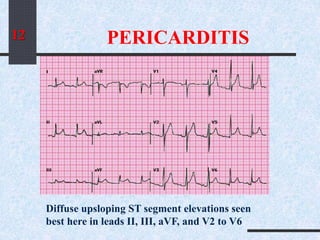 PERICARDITIS
Diffuse upsloping ST segment elevations seen
best here in leads II, III, aVF, and V2 to V6
12
 