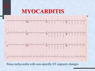 MYOCARDITIS
Sinus tachycardia with non-specific ST segment changes
13
 