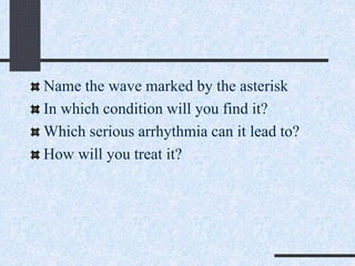 Name the wave marked by the asterisk
In which condition will you find it?
Which serious arrhythmia can it lead to?
How will you treat it?
 