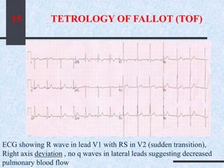 ECG showing R wave in lead V1 with RS in V2 (sudden transition),
Right axis deviation , no q waves in lateral leads suggesting decreased
pulmonary blood flow
TETROLOGY OF FALLOT (TOF)15
 