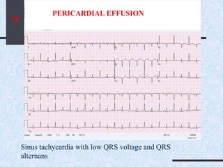 PERICARDIAL EFFUSION
Sinus tachycardia with low QRS voltage and QRS
alternans
16
 