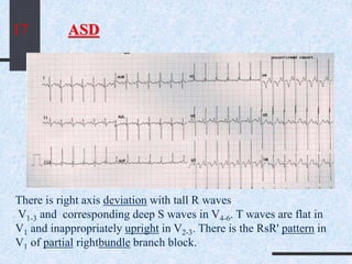 ASD
There is right axis deviation with tall R waves
V1-3 and corresponding deep S waves in V4-6. T waves are flat in
V1 and inappropriately upright in V2-3. There is the RsR' pattern in
V1 of partial rightbundle branch block.
17
 