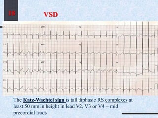 VSD
The Katz-Wachtel sign is tall diphasic RS complexes at
least 50 mm in height in lead V2, V3 or V4 – mid
precordial leads
18
 