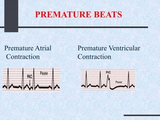 PREMATURE BEATS
Premature Ventricular
Contraction
Premature Atrial
Contraction
 