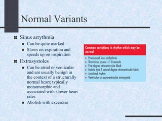 Normal Variants
Sinus arrythmia
 Can be quite marked
 Slows on expiration and
speeds up on inspiration
Extrasystoles
 Can be atrial or venticular
and are usually benign in
the context of a structurally
normal heart; typically
monomorphic and
associated with slower heart
rates
 Abolish with excercise
 