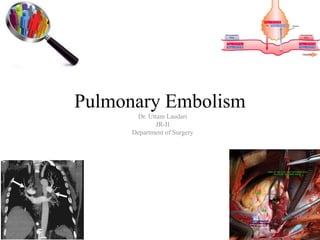 Pulmonary Embolism
Dr. Uttam Laudari
JR-II
Department of Surgery
 