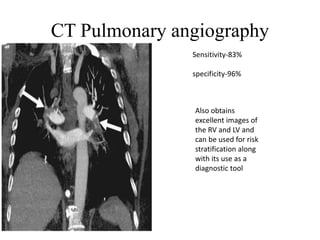 CT Pulmonary angiography
Sensitivity-83%
specificity-96%
Also obtains
excellent images of
the RV and LV and
can be used for risk
stratification along
with its use as a
diagnostic tool
 