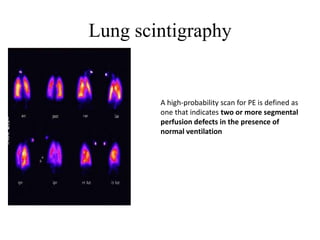 Lung scintigraphy
A high-probability scan for PE is defined as
one that indicates two or more segmental
perfusion defects in the presence of
normal ventilation
 