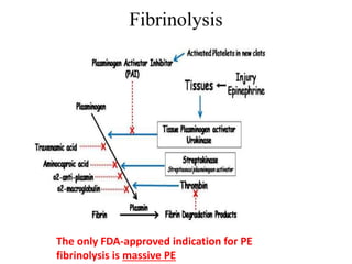 Fibrinolysis
The only FDA-approved indication for PE
fibrinolysis is massive PE
 