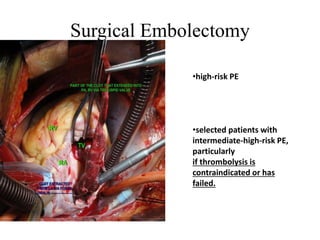 Surgical Embolectomy
•high-risk PE
•selected patients with
intermediate-high-risk PE,
particularly
if thrombolysis is
contraindicated or has
failed.
 