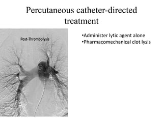 Percutaneous catheter-directed
treatment
•Administer lytic agent alone
•Pharmacomechanical clot lysis
 