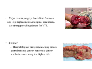 • Major trauma, surgery, lower limb fractures
and joint replacements ,and spinal cord injury,
are strong provoking factors for VTE.
• Cancer
– Haematological malignancies, lung cancer,
gastrointestinal cancer, pancreatic cancer
and brain cancer carry the highest risk
 