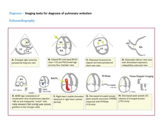 Diagnosis - Imaging tests for diagnosis of pulmonary embolism
Echocardiography
 