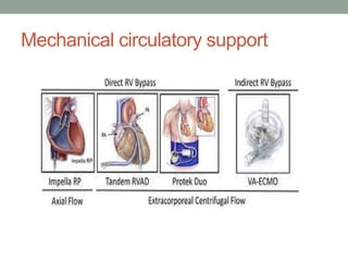 Mechanical circulatory support
 
