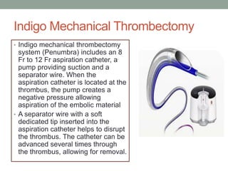 Indigo Mechanical Thrombectomy
• Indigo mechanical thrombectomy
system (Penumbra) includes an 8
Fr to 12 Fr aspiration catheter, a
pump providing suction and a
separator wire. When the
aspiration catheter is located at the
thrombus, the pump creates a
negative pressure allowing
aspiration of the embolic material
• A separator wire with a soft
dedicated tip inserted into the
aspiration catheter helps to disrupt
the thrombus. The catheter can be
advanced several times through
the thrombus, allowing for removal.
 