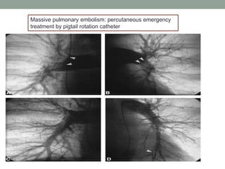 Massive pulmonary embolism: percutaneous emergency
treatment by pigtail rotation catheter
 