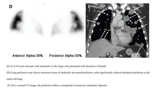 Pulmonary embolism ventilation perfusion scan | PPTX