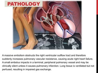 A massive embolism obstructs the right ventricular outflow tract and therefore
suddenly increases pulmonary vascular resistance, causing acute right heart failure.
A small embolus impacts in a terminal, peripheral pulmonary vessel and may be
clinically silent unless it causes pulmonary infarction. Lung tissue is ventilated but not
perfused, resulting in impaired gas exchange.
PATHOLOGY
 