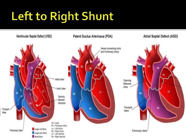 CONGENITAL HEART DISEASE