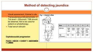 Cephalocaudal progression
FACE > NECK > CHEST > ABDOMEN
> LIMBS
⚫ Visual assessment, Kramer’s rule
⚫ Transcutaneous bilirubinometer- if
Tcb level > 200umol/l, TSB should
be obtained. Not to be used for
patient on phototherapy
⚫ Total serum bilirubin
Method of detecting jaundice
 