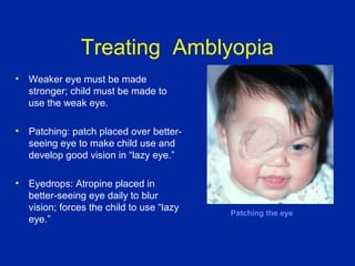 Peadiatric Eye Conditions | PPT