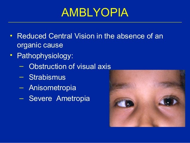 peadiatric eye conditions refraction vs reflection of light