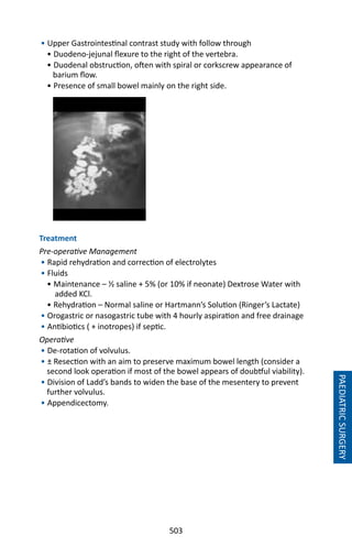 503
• Upper Gastrointestinal contrast study with follow through
• Duodeno-jejunal flexure to the right of the vertebra.
• Duodenal obstruction, often with spiral or corkscrew appearance of
barium flow.
• Presence of small bowel mainly on the right side.
Treatment
Pre-operative Management
• Rapid rehydration and correction of electrolytes
• Fluids
• Maintenance – ½ saline + 5% (or 10% if neonate) Dextrose Water with
added KCl.
• Rehydration – Normal saline or Hartmann’s Solution (Ringer’s Lactate)
• Orogastric or nasogastric tube with 4 hourly aspiration and free drainage
• Antibiotics ( + inotropes) if septic.
Operative
• De-rotation of volvulus.
• ± Resection with an aim to preserve maximum bowel length (consider a
second look operation if most of the bowel appears of doubtful viability).
• Division of Ladd’s bands to widen the base of the mesentery to prevent
further volvulus.
• Appendicectomy.
PAEDIATRICSURGERY
 