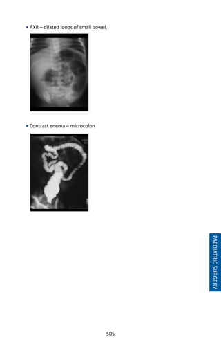 505
• AXR – dilated loops of small bowel.
• Contrast enema – microcolon
PAEDIATRICSURGERY
 