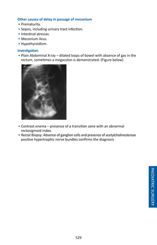 529
Other causes of delay in passage of meconium
• Prematurity.
• Sepsis, including urinary tract infection.
• Intestinal atresias.
• Meconium ileus.
• Hypothyroidism.
Investigation
• Plain Abdominal X-ray – dilated loops of bowel with absence of gas in the
rectum, sometimes a megacolon is demonstrated. (Figure below)
• Contrast enema – presence of a transition zone with an abnormal
rectosigmoid index.
• Rectal Biopsy: Absence of ganglion cells and presence of acetylcholinesterase
positive hypertrophic nerve bundles confirms the diagnosis
PAEDIATRICSURGERY
 