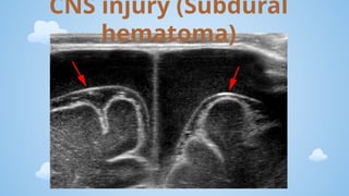 Non Incapacitating Injury Paediatric trauma and NAI(Non accidental injuries).pptx