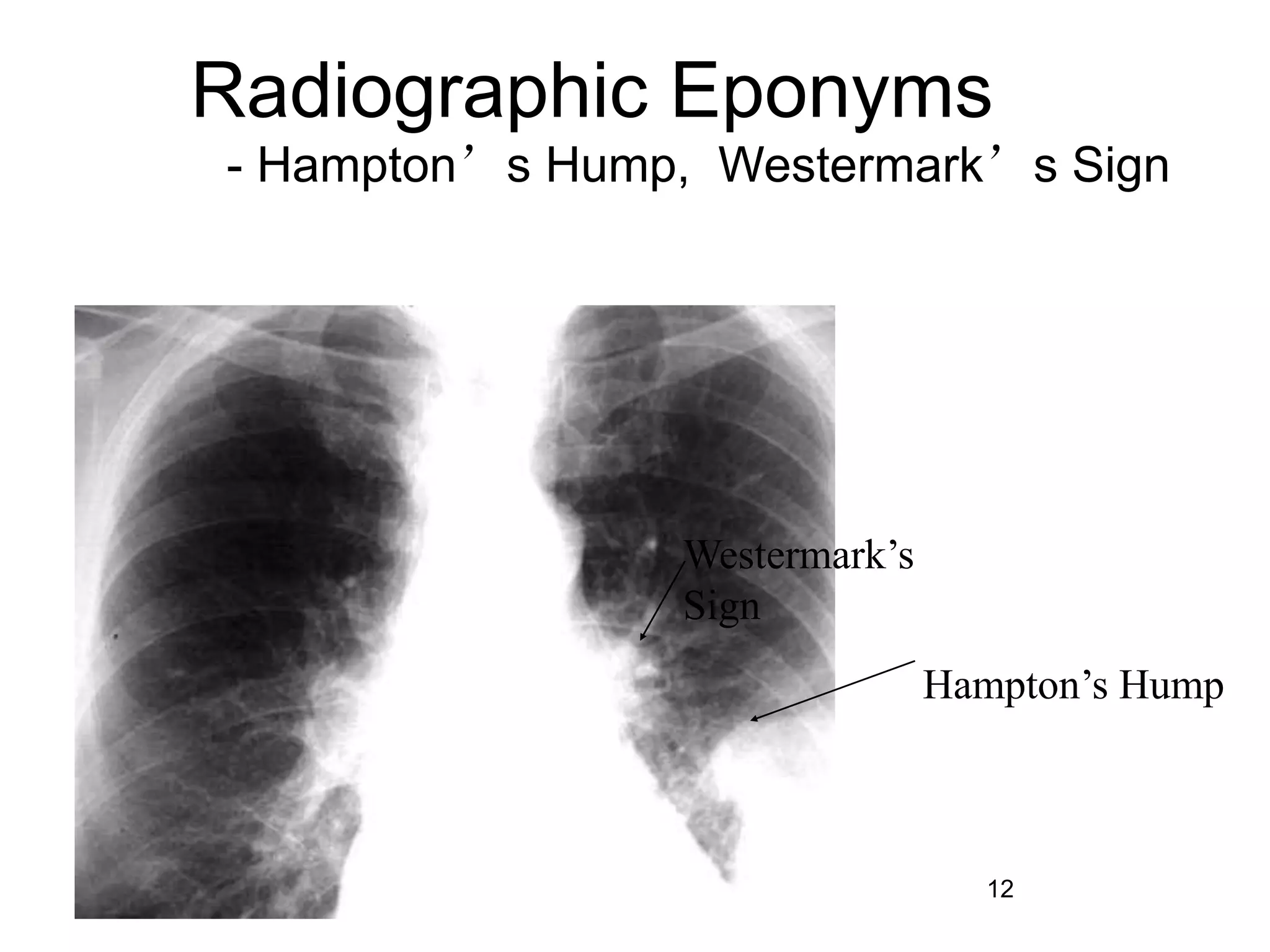 12
Radiographic Eponyms
- Hampton’s Hump, Westermark’s Sign
Westermark’s
Sign
Hampton’s Hump
 