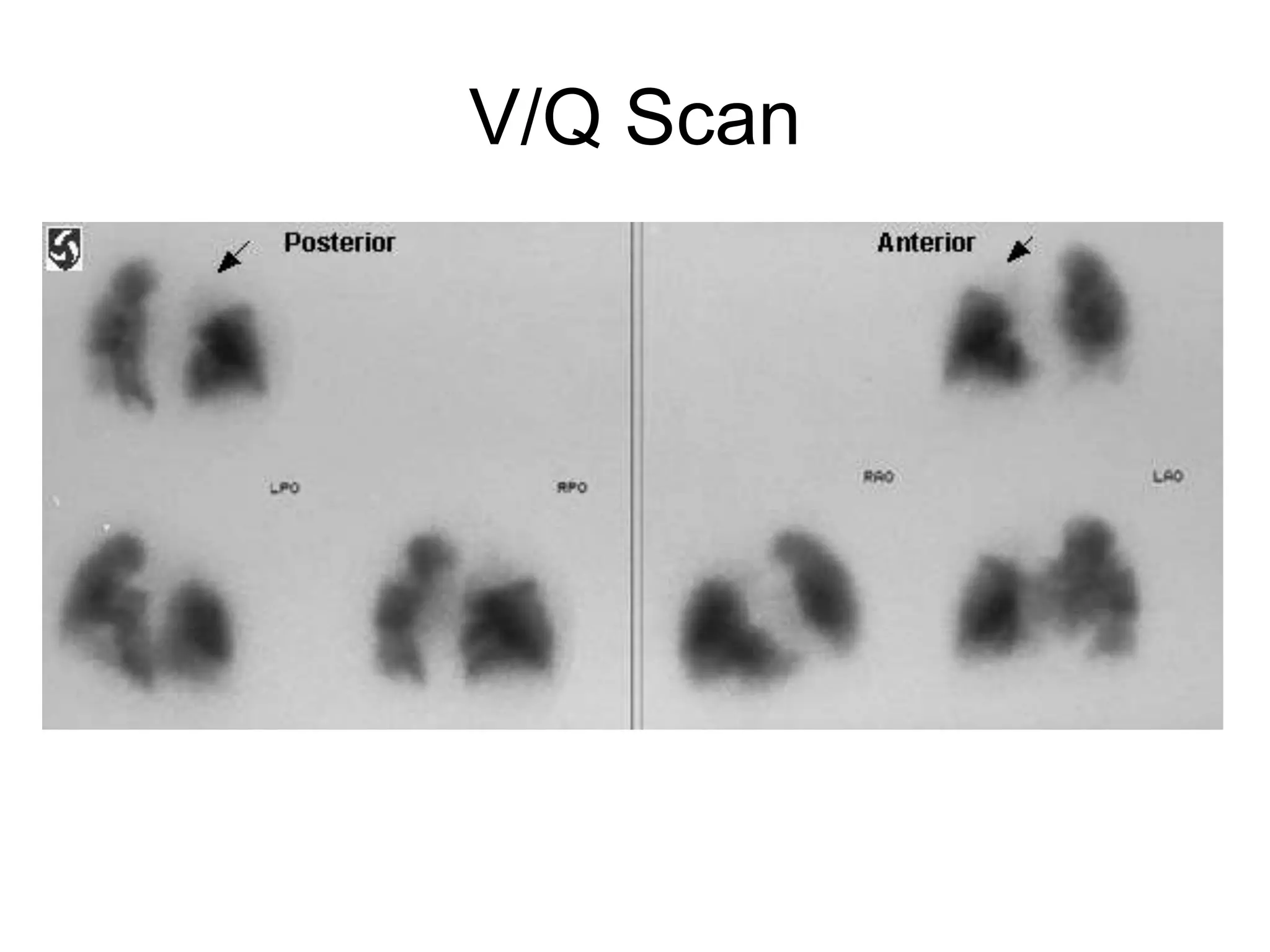V/Q Scan
 