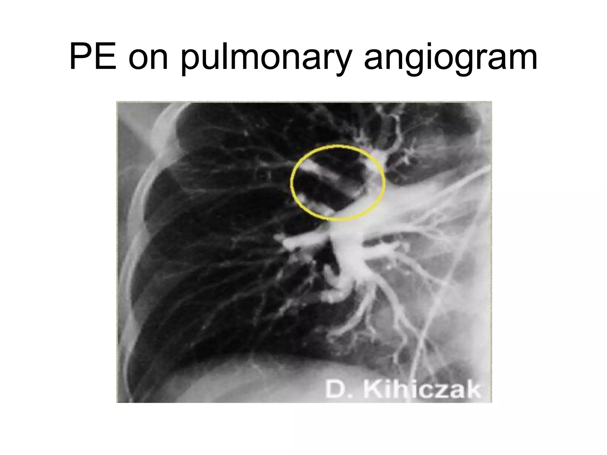 PE on pulmonary angiogram
 