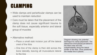 Tibia Clamp Pearls and pitfalls with im nailing of proximal tibia fractures | PPTX