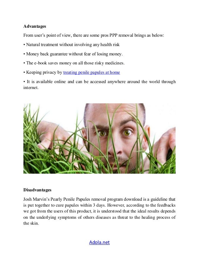 Pearly Penile Papules Removal Naturally Pearly Penile Papules Removal Naturally