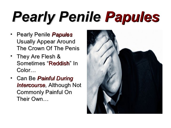 pearly penile papules reason
