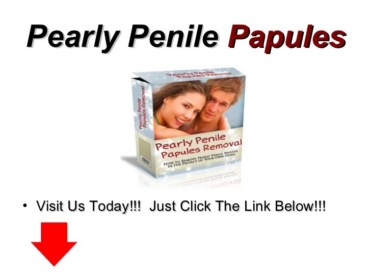 pearly penile papules treatment home remedies