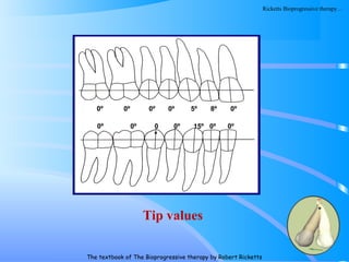 123
0º 0º 0º 0º 5º 8º 0º
0º 0º 0
º
0º 15º 0º 0º
Tip values
The textbook of The Bioprogressive therapy by Robert Ricketts
Ricketts Bioprogressive therapy…
 