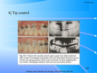 4] Tip control
133
Anthony Viasis. Bioefficient therapy. JCO 1995 Sept.:552-68
Viasis brackets…
 