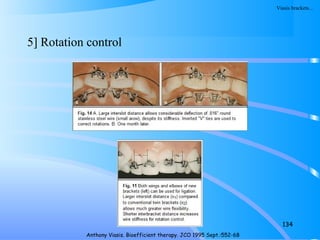 5] Rotation control
134
Anthony Viasis. Bioefficient therapy. JCO 1995 Sept.:552-68
Viasis brackets…
 