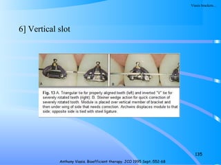 6] Vertical slot
135
Anthony Viasis. Bioefficient therapy. JCO 1995 Sept.:552-68
Viasis brackets…
 