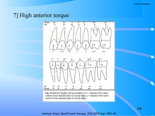 7] High anterior torque
136
Anthony Viasis. Bioefficient therapy. JCO 1995 Sept.:552-68
Viasis brackets…
 