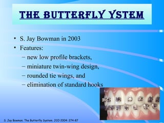 The bUTTeRfLY YSTeM
• S. Jay Bowman in 2003
• Features:
– new low profile brackets,
– miniature twin-wing design,
– rounded tie wings, and
– elimination of standard hooks
140
S. Jay Bowman. The Butterfly System. JCO 2004: 274-87
 