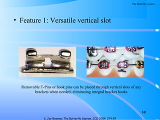 • Feature 1: Versatile vertical slot
141
S. Jay Bowman. The Butterfly System. JCO 2004: 274-87
Removable T-Pins or hook pins can be placed through vertical slots of any
brackets when needed, eliminating integral bracket hooks
The Butterfly system…
 