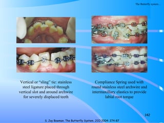 142
S. Jay Bowman. The Butterfly System. JCO 2004: 274-87
Vertical or “sling” tie: stainless
steel ligature placed through
vertical slot and around archwire
for severely displaced teeth
Compliance Spring used with
round stainless steel archwire and
intermaxillary elastics to provide
labial root torque
The Butterfly system…
 